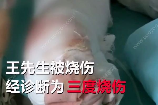 不慎引燃酒精桶，男子家中吃燒烤吃成三度燒傷(1)