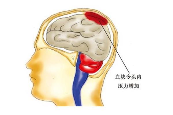 腦溢血患者家屬質(zhì)疑被過期藥加重病情，醫(yī)院:只用了一瓶(4)