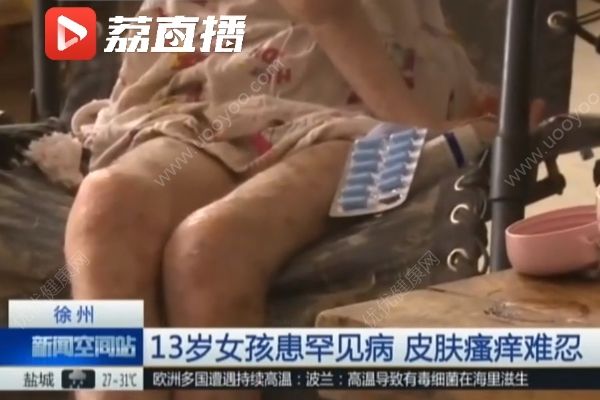 女孩患罕見病最怕熱，家貧買不起空調只靠奶奶背起來回走(3)