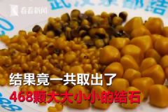 愛吃油炸長(zhǎng)468顆結(jié)石，油炸食品的危害有哪些？[多圖]