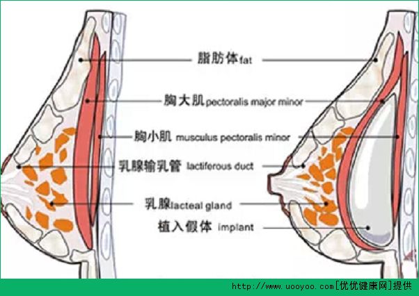 隆胸手術(shù)后可以母乳喂養(yǎng)嗎？隆胸后可以喂奶哺乳嗎？(2)