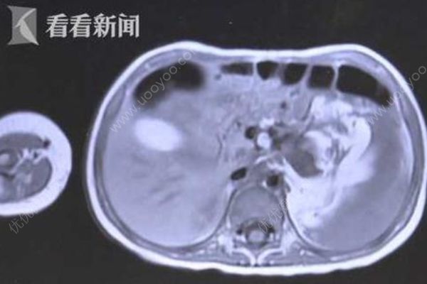 3歲女童腹腔長直徑約15厘米腫瘤，嬰幼兒腫瘤如何早發(fā)現(xiàn)？(2)