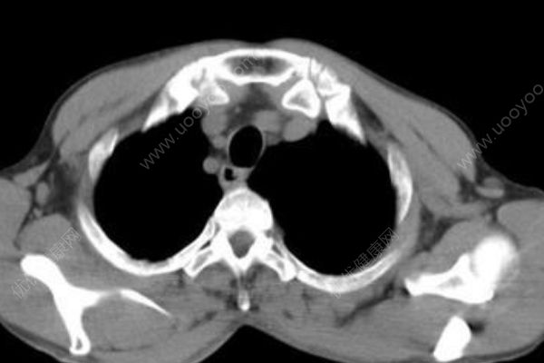 30歲小伙沒力氣上二樓，塵肺病肺已經(jīng)千瘡百孔(4)