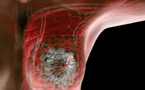 乳腺癌的早期信號是什么？誘發(fā)乳腺疾病的原因是什么？(1)