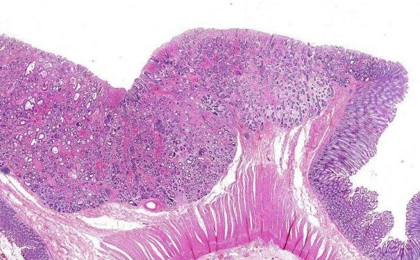 直腸癌有哪些病因？直腸癌有何治療方法？(3)