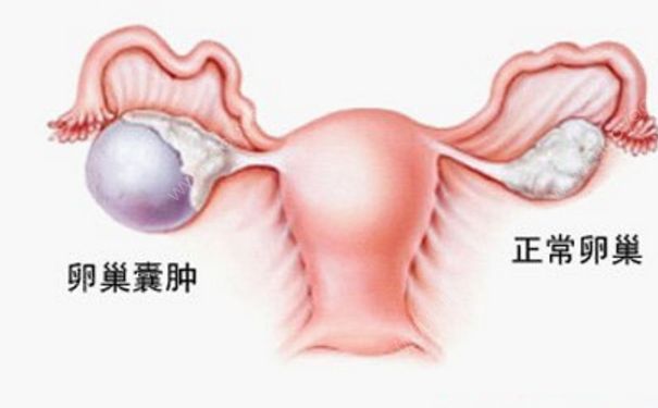 卵巢腫瘤嚴(yán)重嗎？卵巢腫瘤手術(shù)(1)