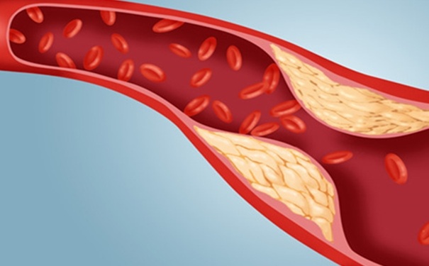 動脈粥樣硬化有哪些危害？動脈粥樣硬化怎么調(diào)理？(1)