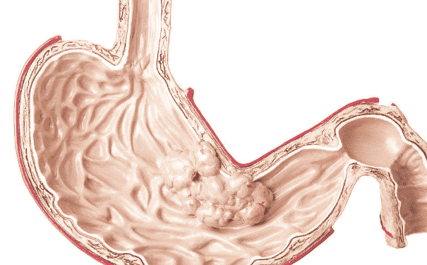 胃癌早期的癥狀有哪些？如何及時發(fā)現(xiàn)胃癌征兆？(1)