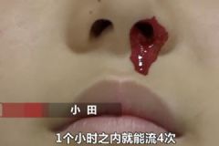 一學(xué)習(xí)就流鼻血！12歲男孩一天流20多次無奈休學(xué)！[多圖]