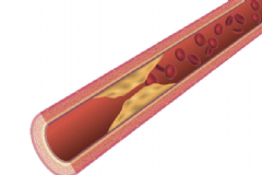 吃哪些食物預(yù)防動(dòng)脈硬化？預(yù)防動(dòng)脈硬化有哪些有效方法？[圖]