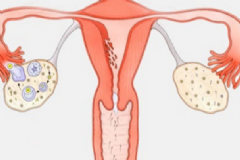 卵巢切除后怎么保養(yǎng)好？卵巢切除后怎么保養(yǎng)？[圖]