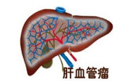 肝血管瘤嚴(yán)重嗎？肝血管瘤的癥狀表現(xiàn)[圖]