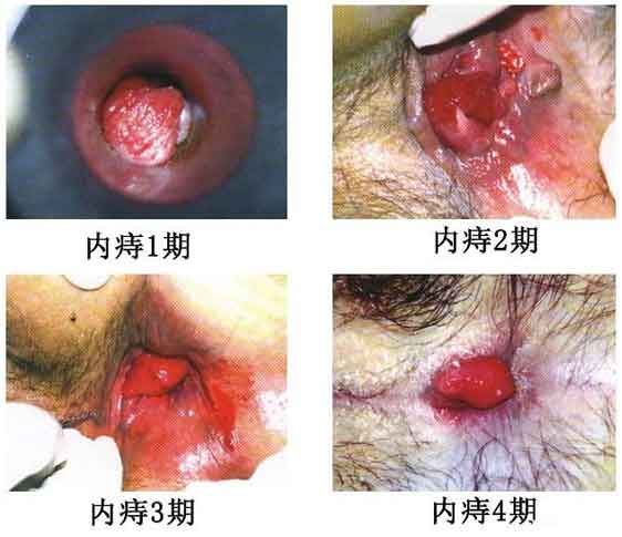 女性痔瘡真人實(shí)拍圖片：網(wǎng)上曝光的7個(gè)小偏方有效治痔瘡