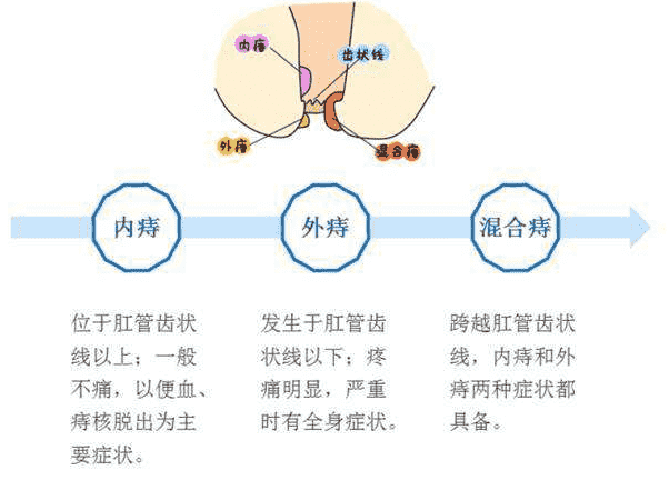 武漢江漢博仕醫(yī)院 痔瘺和痔瘡是一個(gè)病嗎