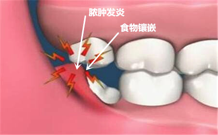 牙菌斑以及食物殘渣等容易對拔智齒的創(chuàng)口造成感染。