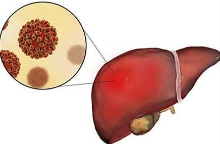 肝病怎么徹底治好？如何預(yù)防肝病