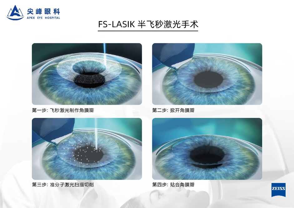 選擇全飛秒還是半飛秒 鄭州尖峰眼科專家提醒 適合自己最重要