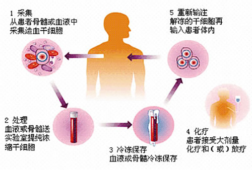 濟(jì)南血液病醫(yī)院科普：骨髓瘤患者自體移植前需要做好哪些準(zhǔn)備？