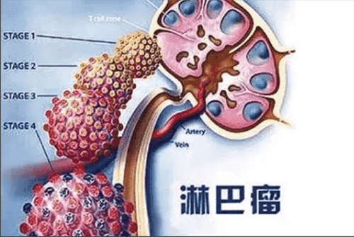 濟(jì)南血液病醫(yī)院科普：淋巴瘤自體移植與異體移植，哪種效果好？