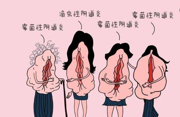 女性在生活中怎樣預(yù)防女性私處炎癥？女性私處炎反復(fù)發(fā)作原因[圖]