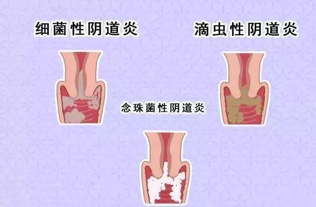 霉菌性陰道炎的表現(xiàn)有哪些？日常需要怎樣護(hù)理？[圖]