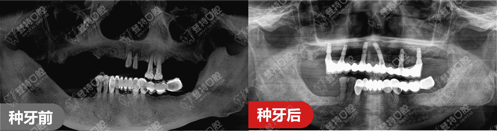 顛覆傳統(tǒng)種牙，佛山登特口腔一日得技術(shù)，一天搞定種牙全過(guò)程