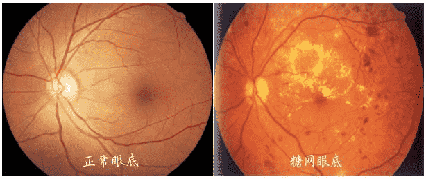合肥愛爾眼科醫(yī)院：糖尿病患者，注意定期檢查眼底