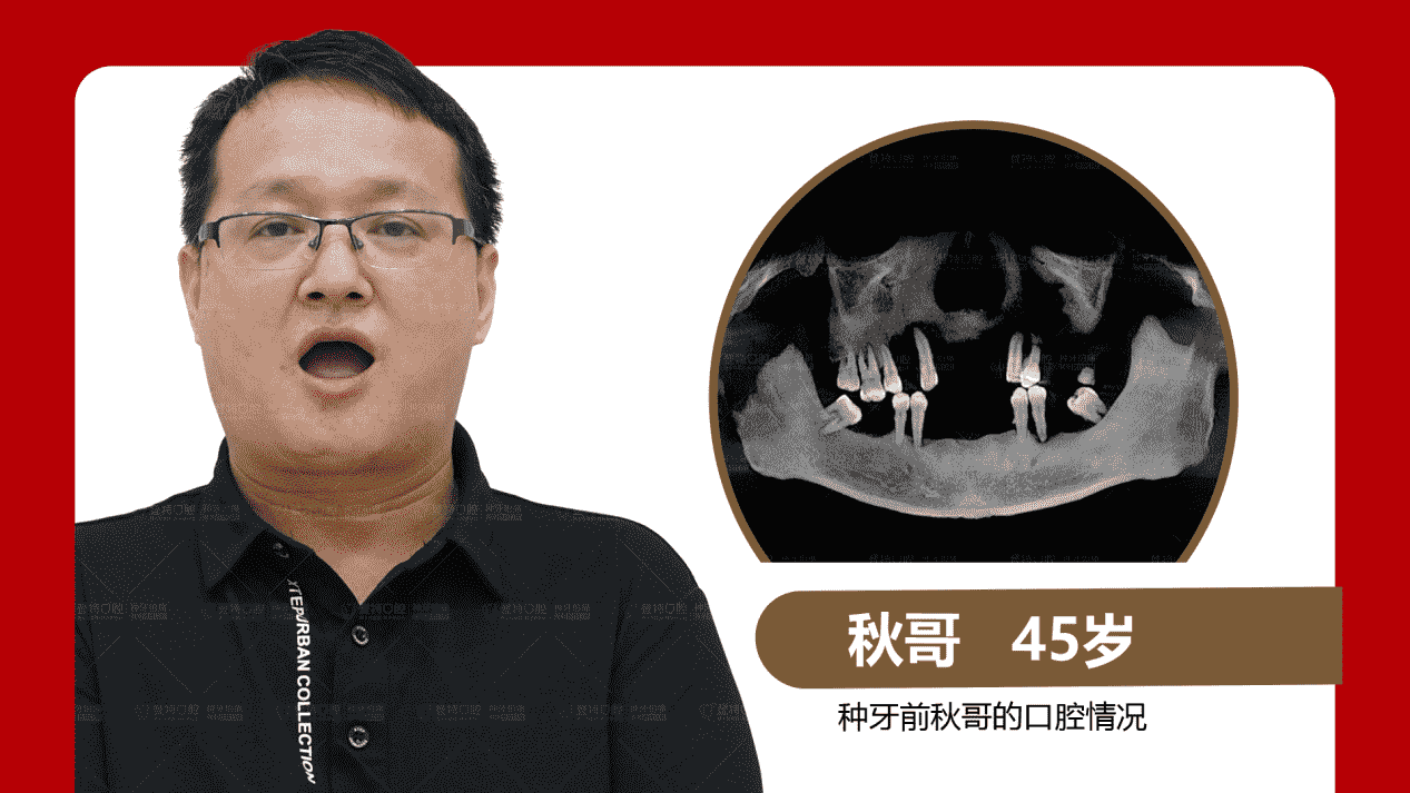 佛山登特口腔：全口半口缺牙修復(fù)方式怎么選？