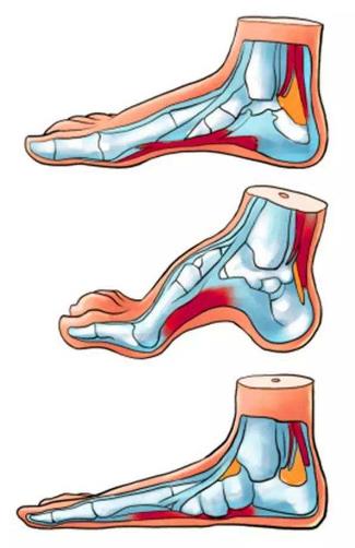 扁平足能跑步嗎？扁平足跑步有什么危害？