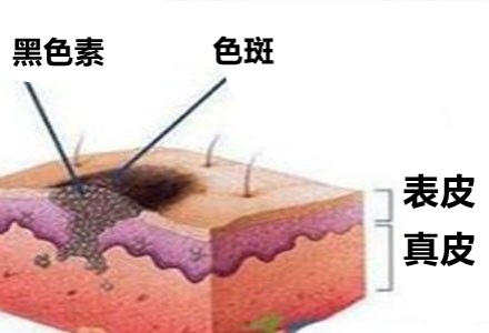 祛斑霜用出終生難愈皮炎，千金散去再也換不回一張健康臉！