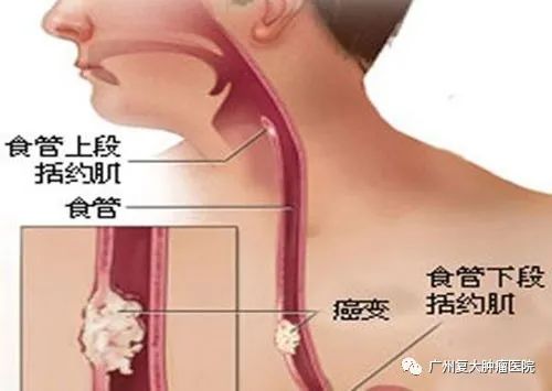 杭州腫瘤醫(yī)院請選擇廣州復(fù)大腫瘤醫(yī)院：食管癌轉(zhuǎn)移后要怎么治療