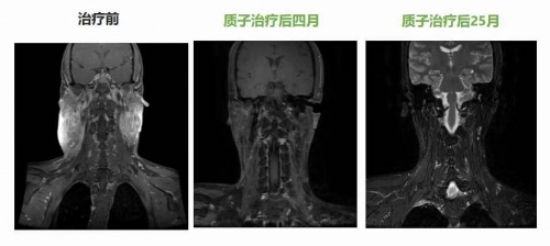 腫瘤放療“皇冠上的明珠”質(zhì)子治療，竟比普通放療更“省錢”