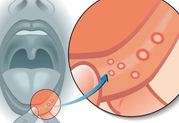 口腔潰瘍是什么原因造成的 消化系統(tǒng)疾病內(nèi)分泌變化遺傳因素