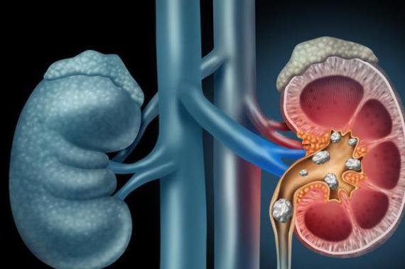 腎結(jié)石怎么能快速排出來(lái) 手術(shù)調(diào)整飲食治療