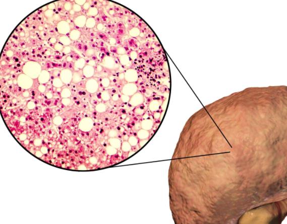 脂肪肝有什么危害 貧血肝臟腫大腹水下肢水腫