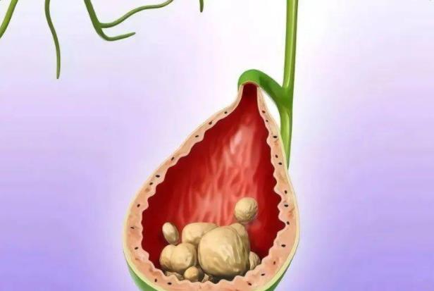 膽結(jié)石不能吃的東西有哪些 高膽固醇脂肪辛辣刺激