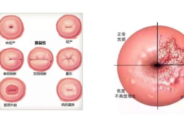 慢性宮頸炎能自愈嗎 復(fù)發(fā)性強及時清潔就診