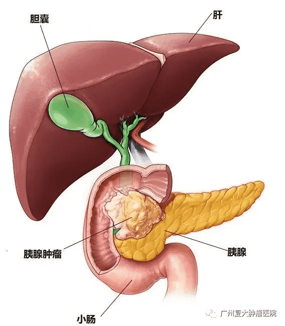 杭州腫瘤醫(yī)院選擇廣州復大腫瘤醫(yī)院：納米刀可以治療胰腺癌嗎