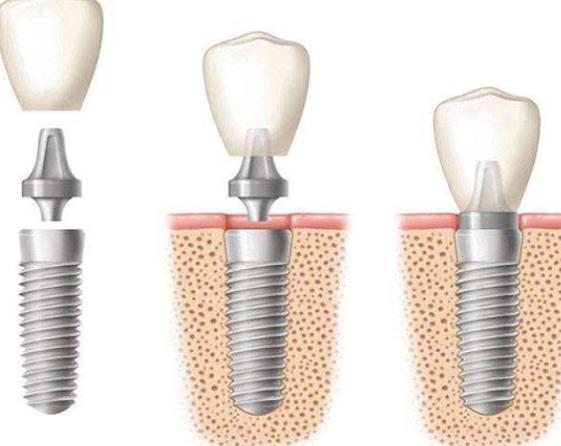 種植牙齒的后遺癥有哪些 感染牙齦增生下唇麻木出血