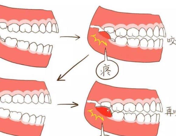 智齒到底要不要拔 建議就醫(yī)萌出者遠(yuǎn)中齦瓣切除