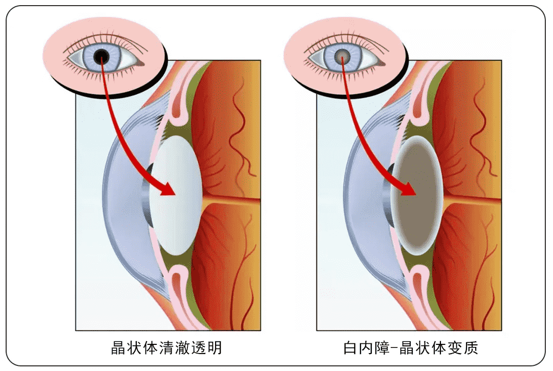 重慶高溫天氣下，普瑞眼科內(nèi)購(gòu)會(huì)護(hù)眼福利來襲