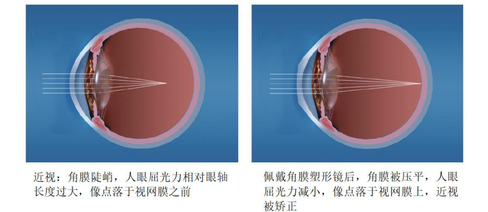 番禺普瑞科學配鏡總動員 OK鏡控制近視增長非常OK