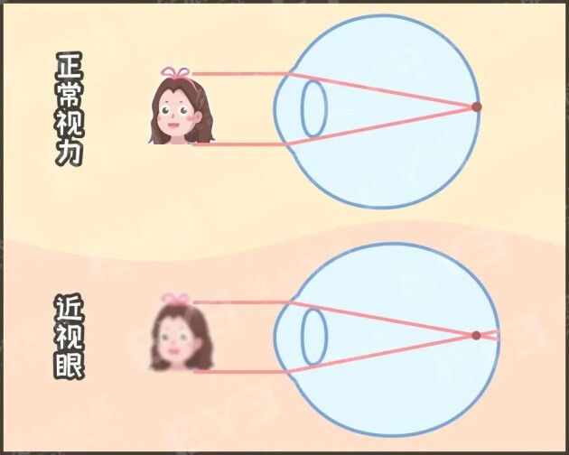 孩子戴上眼鏡度數(shù)會越來越高，確實如此嗎？——合肥愛爾眼科