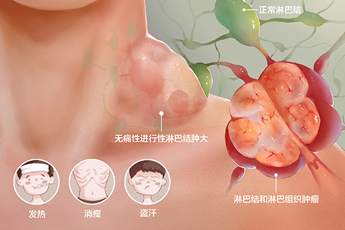  濟(jì)南血液病醫(yī)院科普：淋巴瘤患者的治療方法主要有哪些？