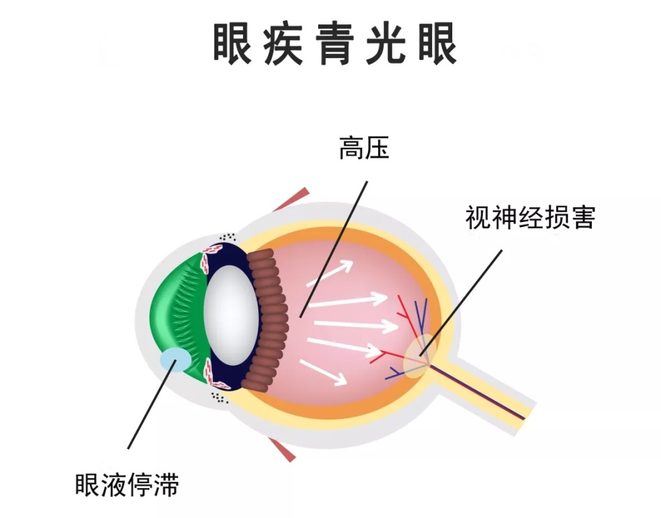 合肥愛(ài)爾眼科：青光眼治療需趁早