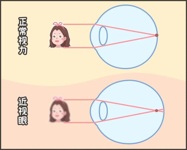 合肥愛爾：「我可以治好你的近視，但不改變度數(shù)。」啥？