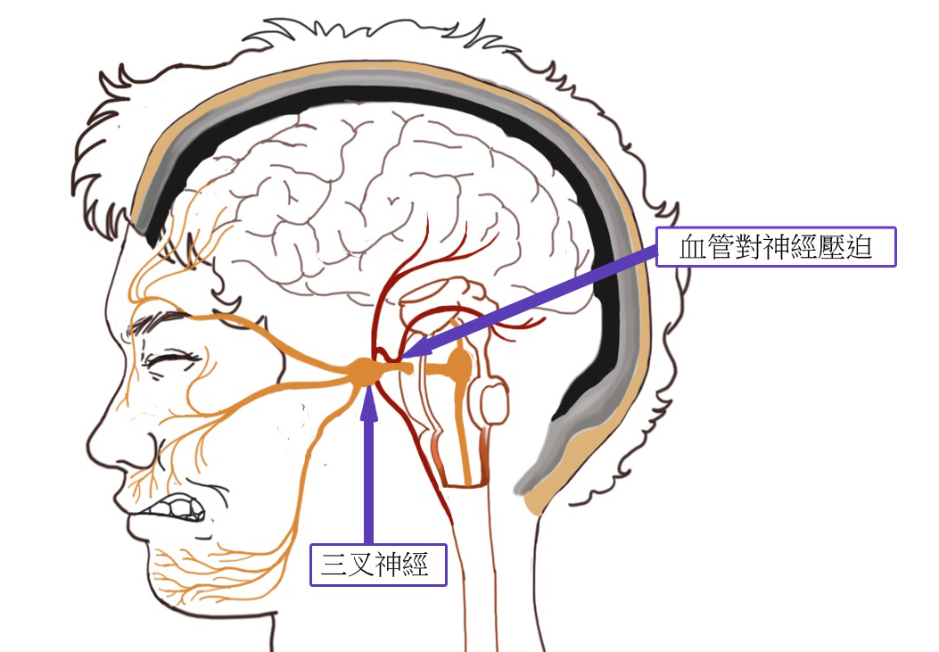 北京廣濟(jì)醫(yī)院好不好，如何治療三叉神經(jīng)痛