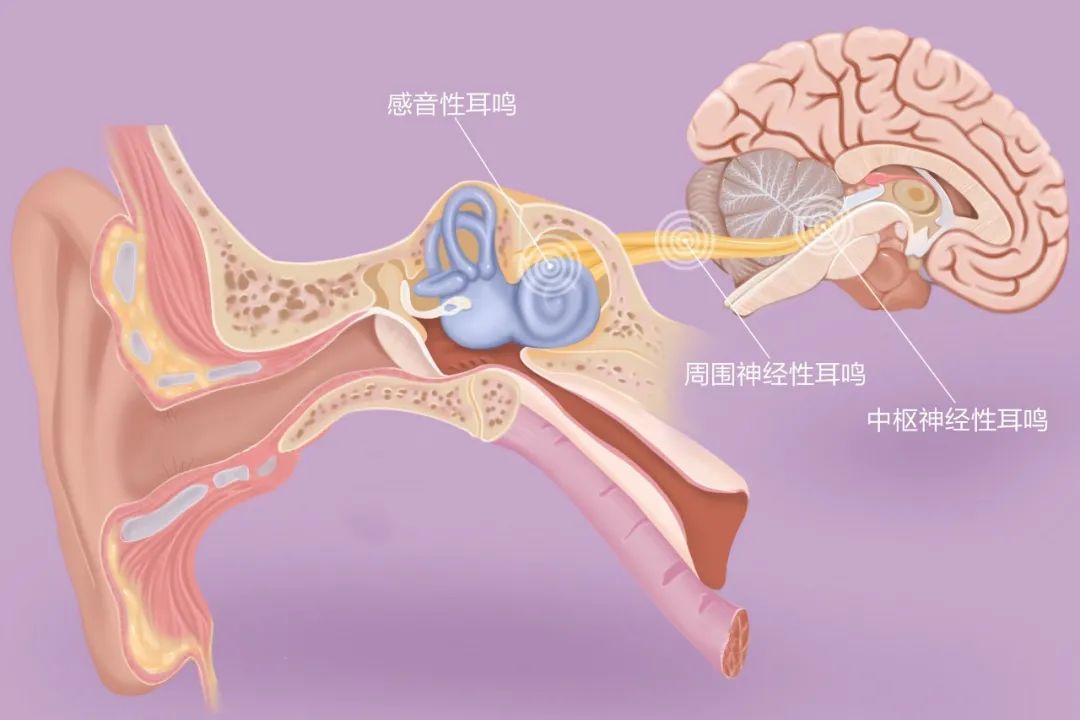 “嚶嚶嚶…”，成都民生耳鼻喉醫(yī)院提醒：耳鳴是身體的警報(bào)，須重視！