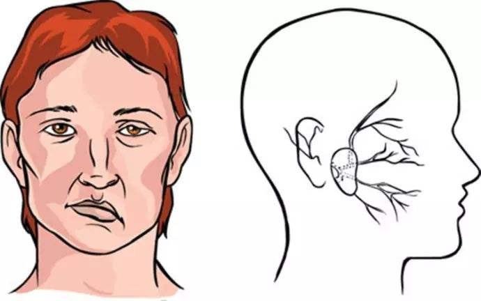 上海健橋醫(yī)院好不好，面癱的兩種常見癥狀和治療方法