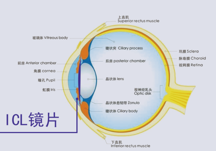  ICL晶體植入術(shù)貴在哪里？合肥普瑞眼科專家來解答（近視手術(shù)鉅惠來襲）